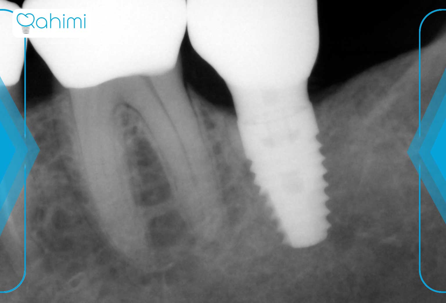 عکس ایکس ری از پایه ایملنت دندانی در لثه
