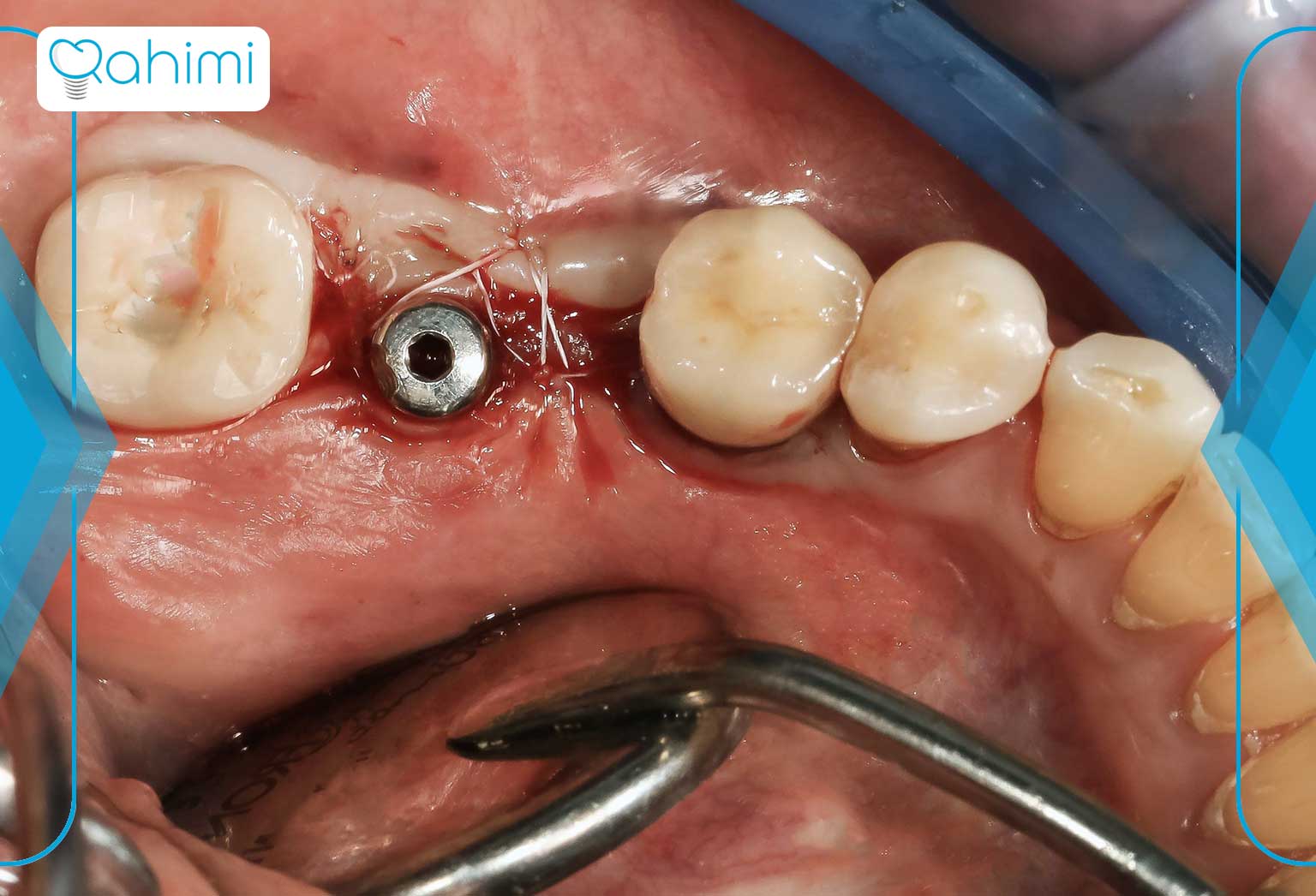 جراحی ایمپلنت دندان در قم