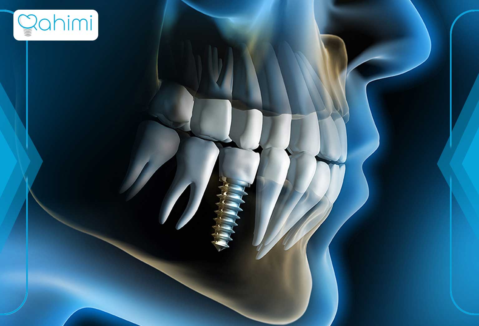 ساختار ایمپلنت دندان