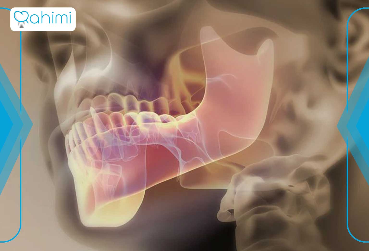 پیوند استخوان در ایمپلنت دندان قم