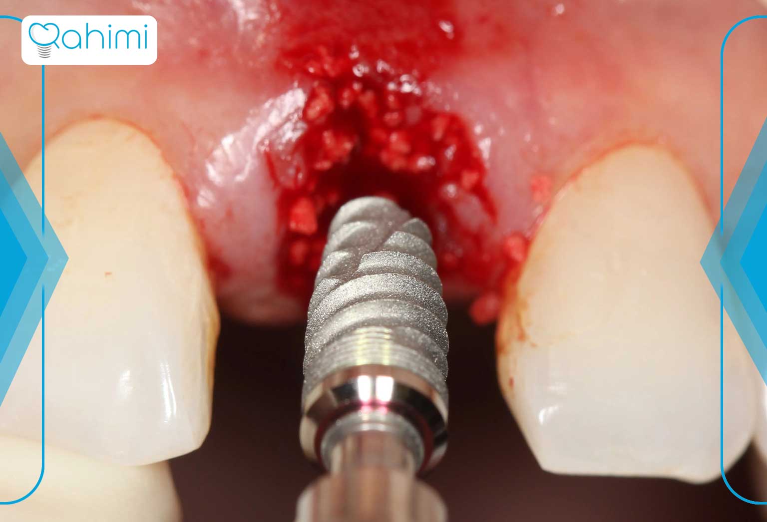 عکس ایمپلنت دندان در قم