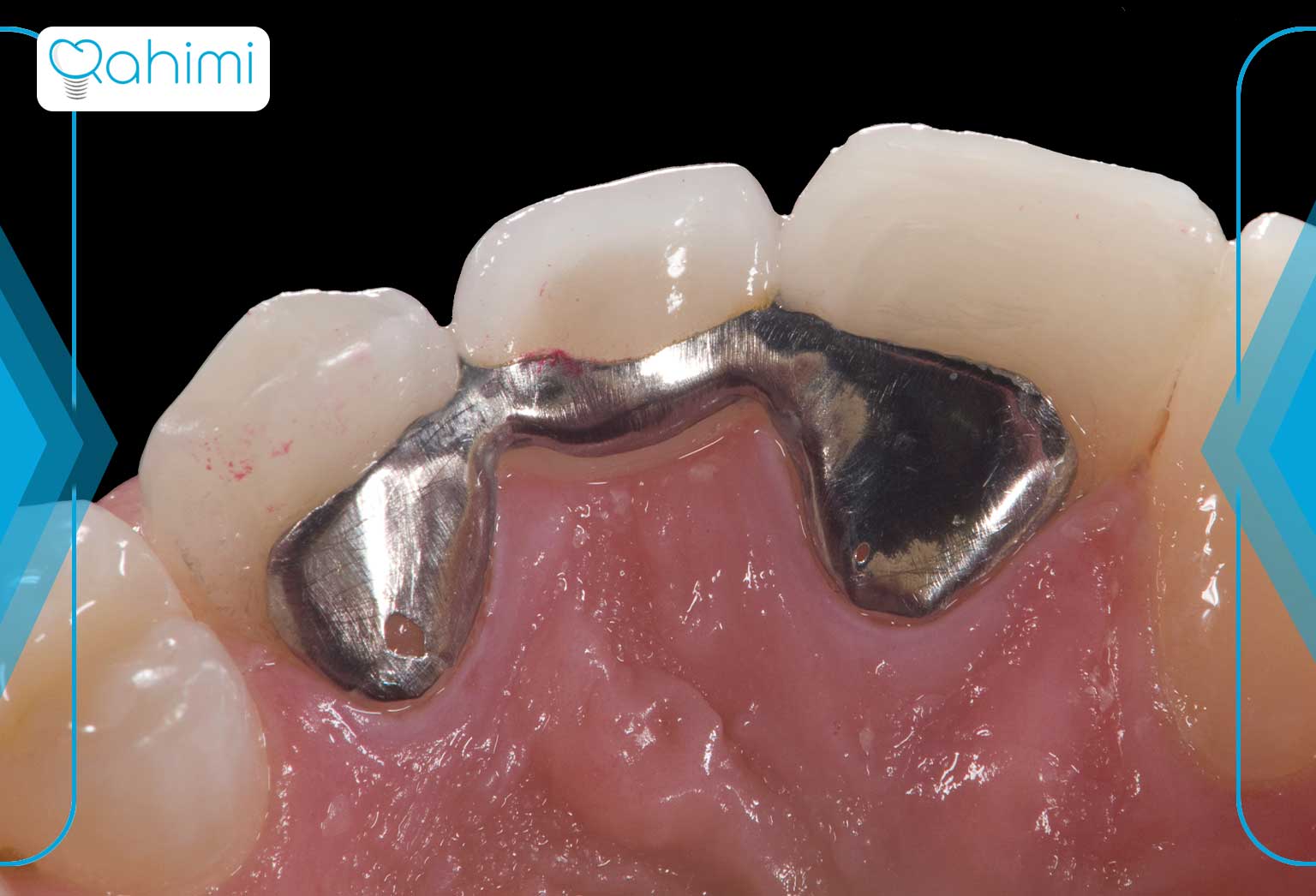 بریج دندان فلزی