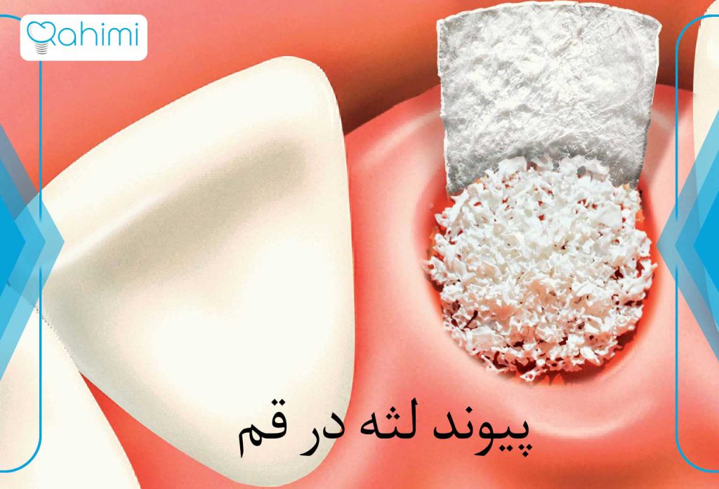جراحی پیوند لثه در قم 1 جراحی پیوند لثه در قم
