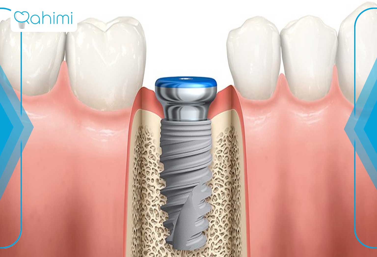 مزایای جراحی  به روش ایمپلنت پانچ 