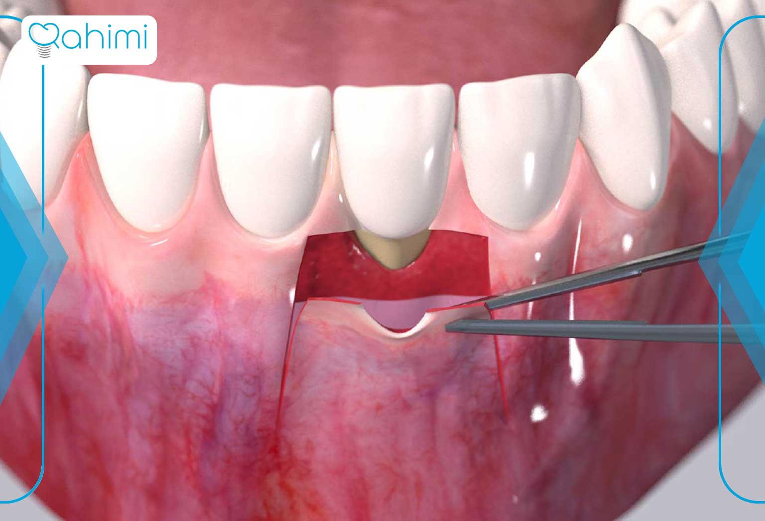 عوارضی که ممکن است با تحلیل لثه (پریودنتیت) ایجاد شود چیست؟