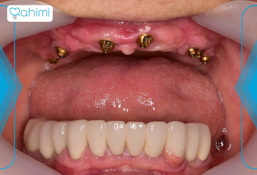 علائم و علل آبسه دندان درمانهای خانگی و فوری + پیشگیری و نکات مهم 11 آبسه دندانی ایمپلنت شده