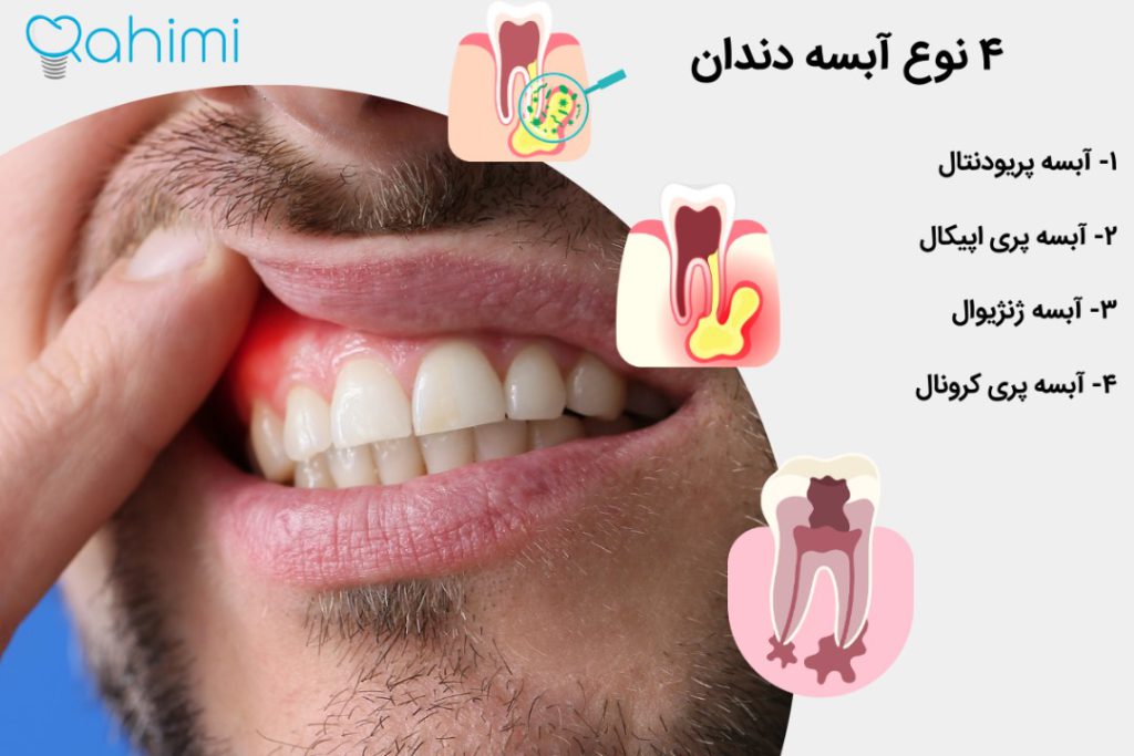 علائم و علل آبسه دندان درمانهای خانگی و فوری + پیشگیری و نکات مهم 2 انواع آبسه دندان