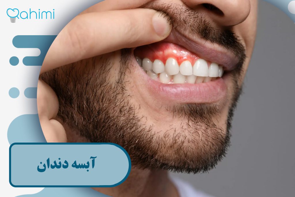 علائم و علل آبسه دندان درمانهای خانگی و فوری + پیشگیری و نکات مهم 50 آبسه دندان
