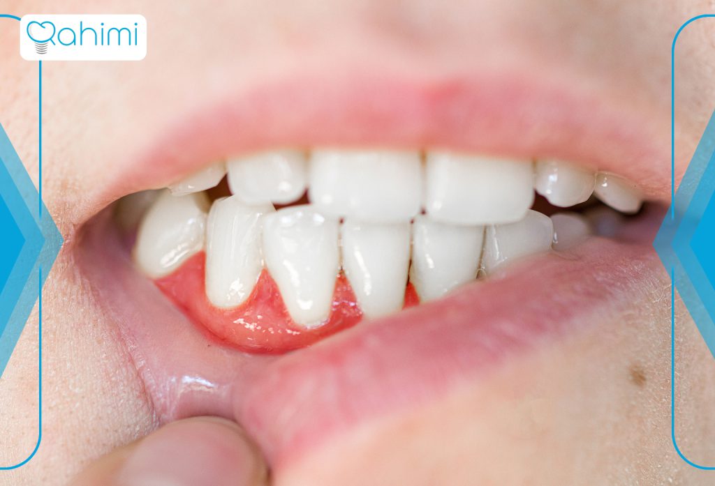 علائم و علل آبسه دندان درمانهای خانگی و فوری + پیشگیری و نکات مهم 1 آبسه دندان