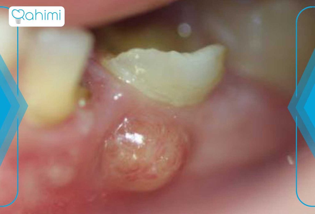 علائم و علل آبسه دندان درمانهای خانگی و فوری + پیشگیری و نکات مهم 3 آبسه لثه