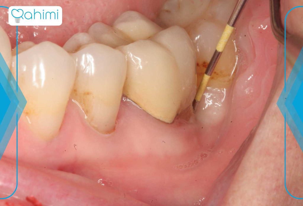 علائم و علل آبسه دندان درمانهای خانگی و فوری + پیشگیری و نکات مهم 14 روشهای حرفهای برای تخلیه آبسه دندان