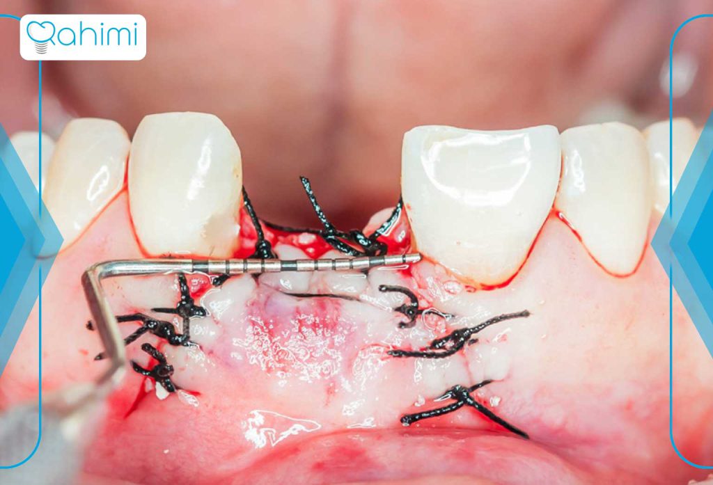تحلیل لثه (پریودنتیت) چیست؟ 5 تحلیل لثه (پریودنتیت) چگونه درمان میشود؟