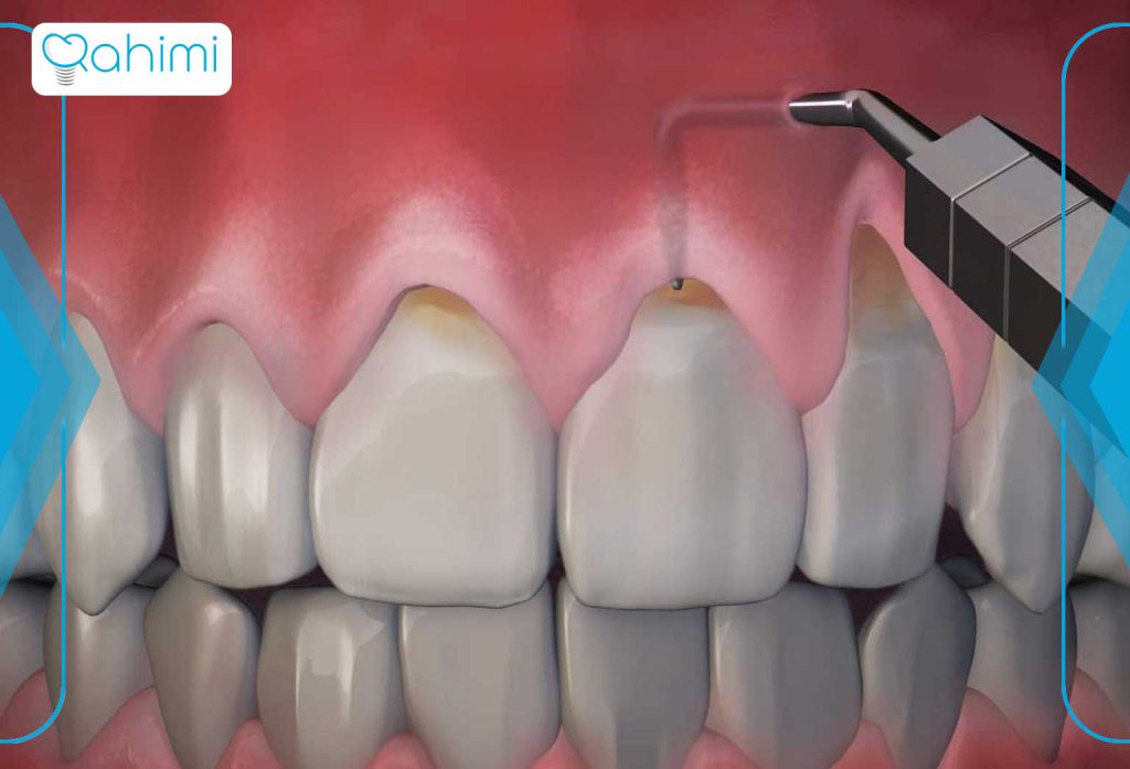 تحلیل لثه (پریودنتیت) چیست؟ 4 تحلیل لثه (پریودنتیت) چگونه تشخیص داده میشود؟