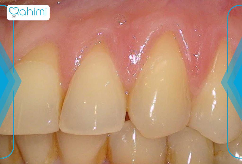 تحلیل لثه (پریودنتیت) چیست؟ 6 تغییرات سبک زندگی و مراقبت در منزل برای جلوگیری از تحلیل لثه (پریودنتیت)