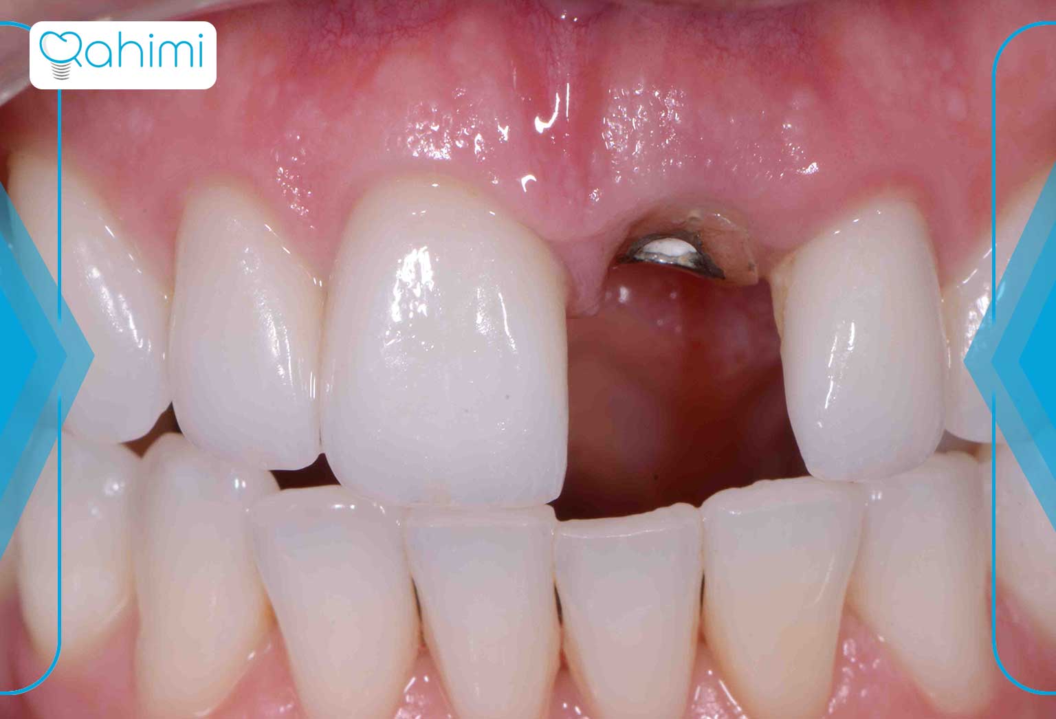 تفاوت بین دندان های بریج و ایمپلنت