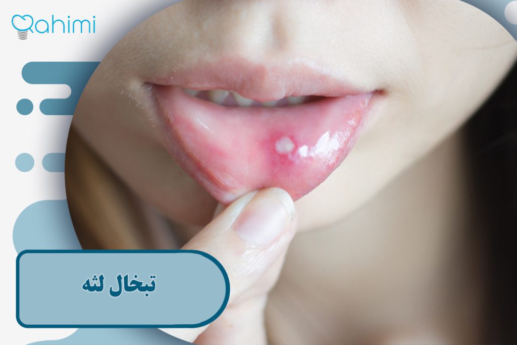 تبخال لثه