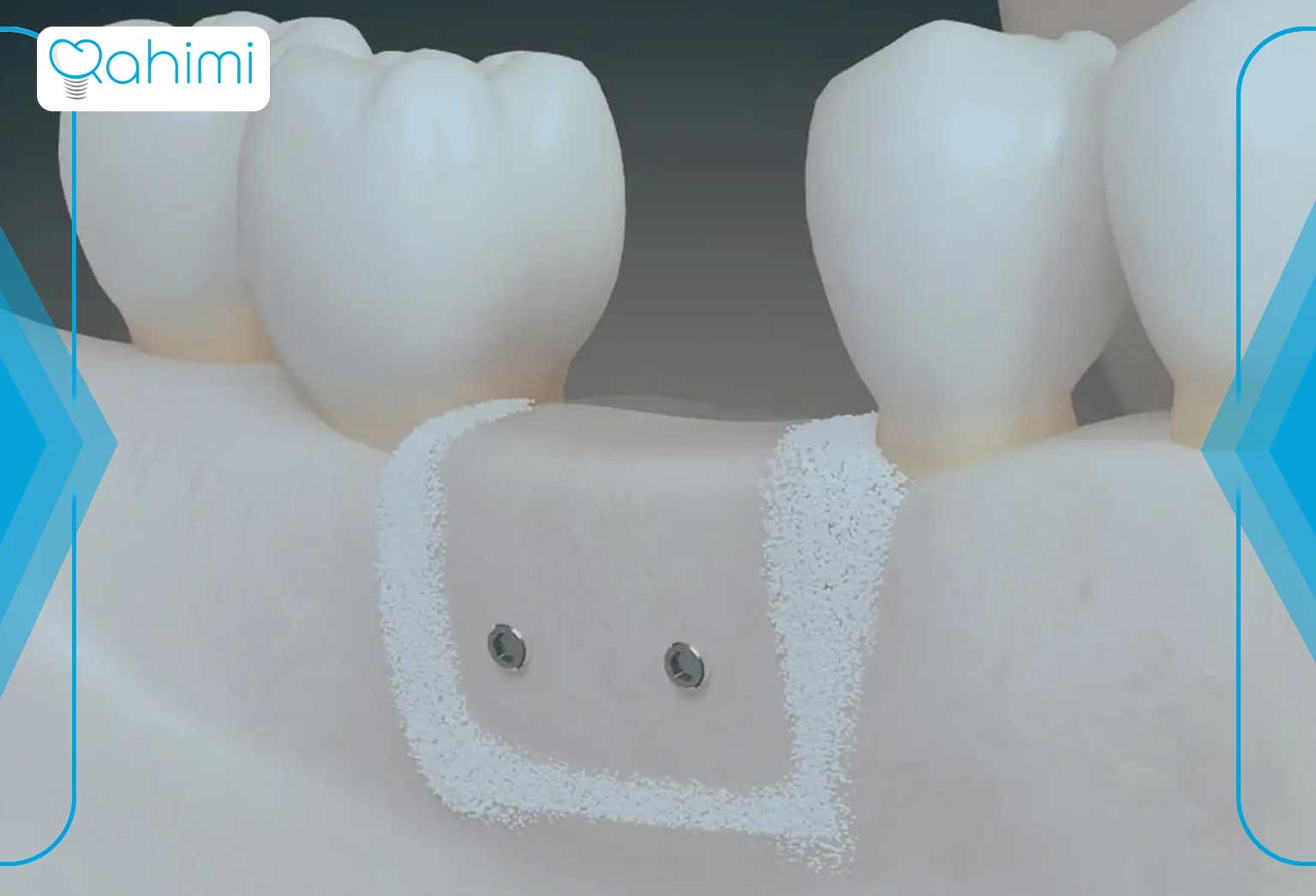 پیوند استخوان در ایمپلنت دندان چقدر رایج است؟