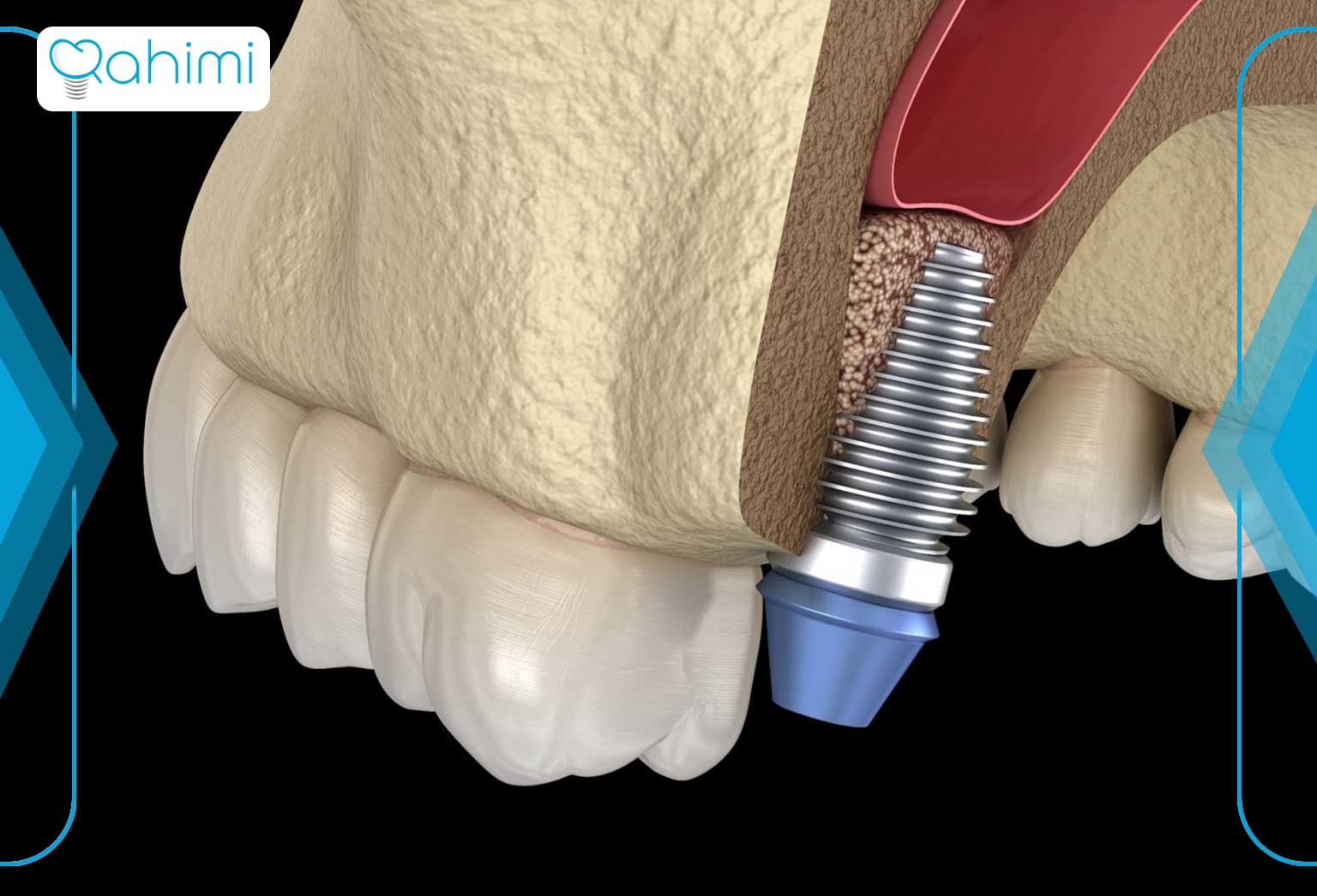 پیوند استخوان در ایمپلنت دندان