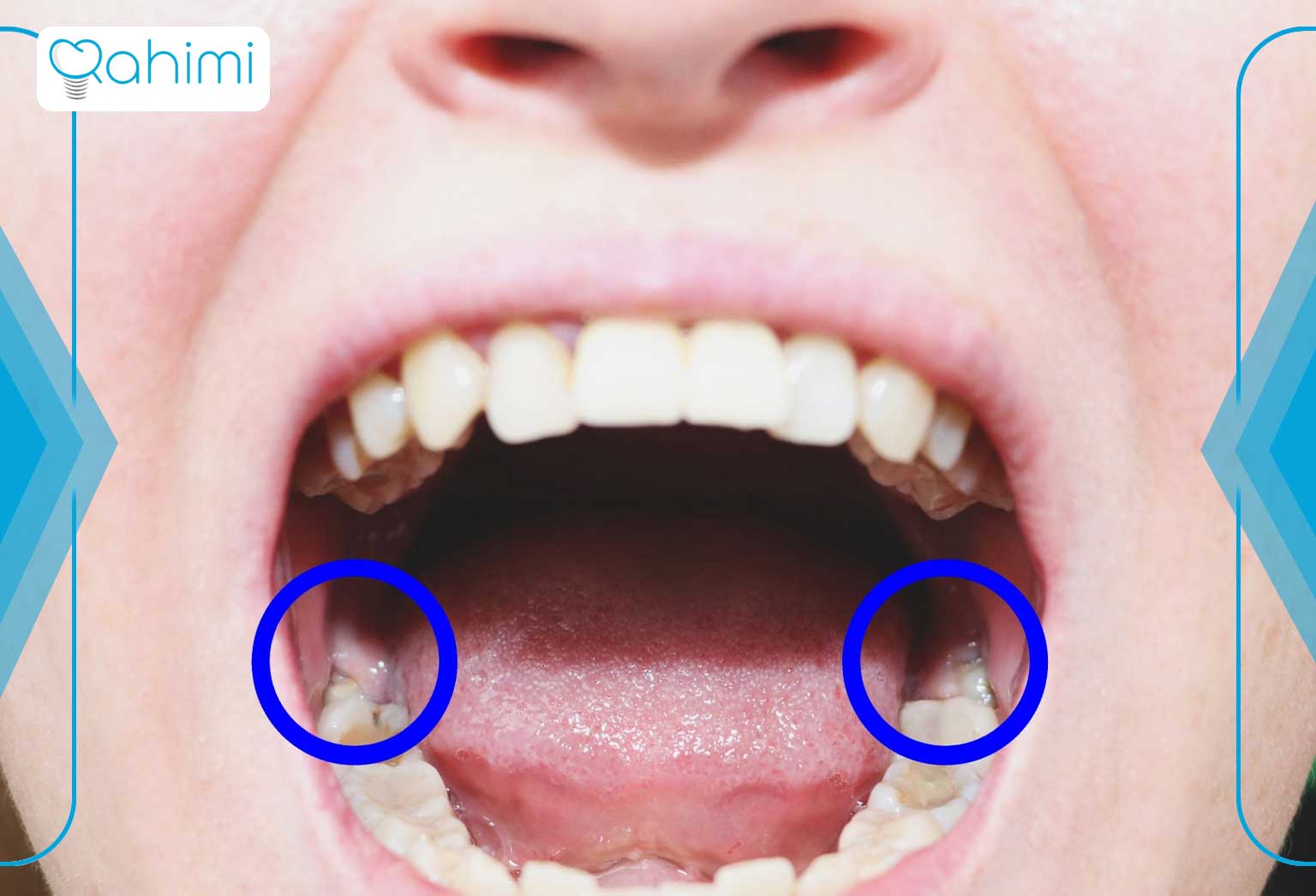 عوارض بعد از جراحی دندان عقل چیست؟