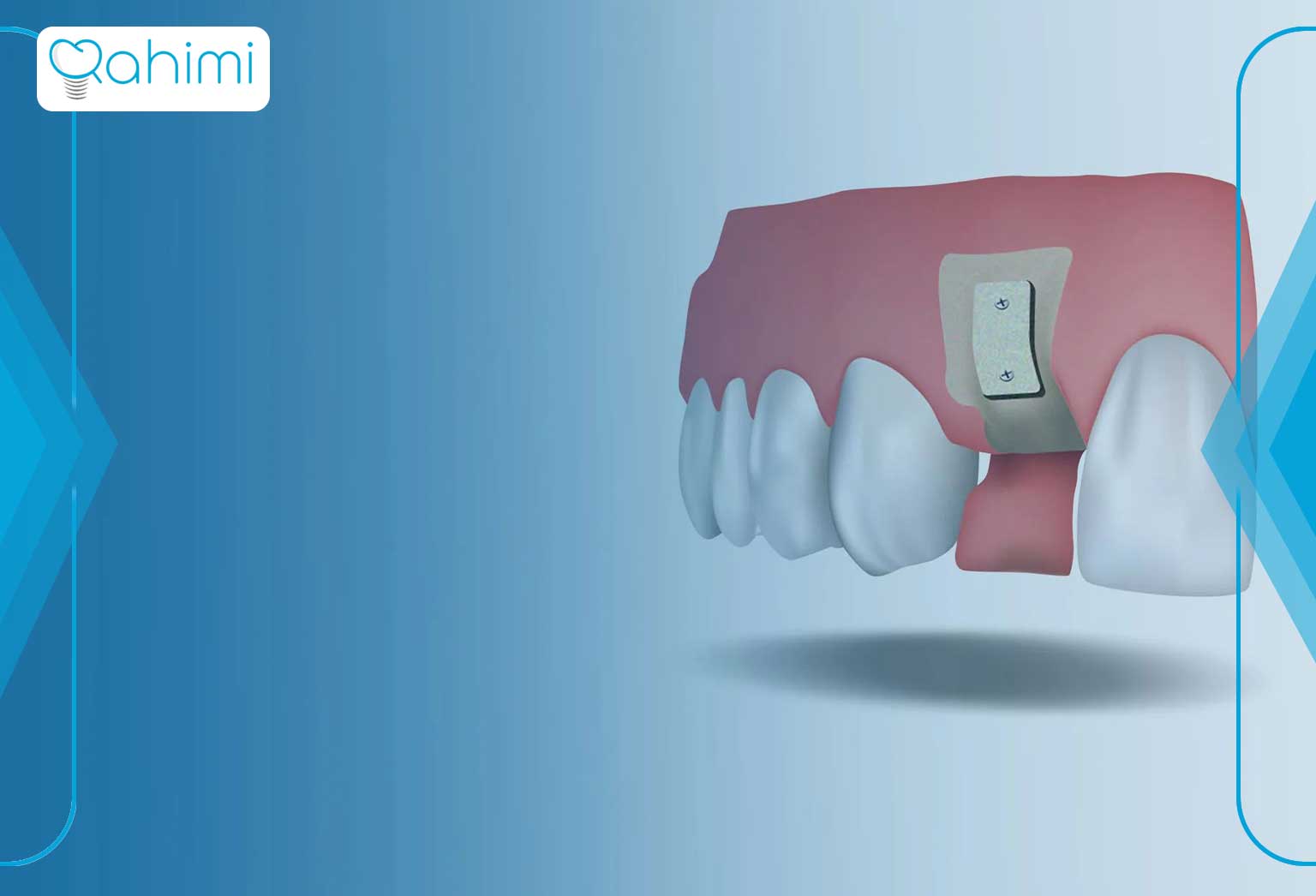 چرا تراکم استخوان در ایمپلنت دندان اهمیت بسیار زیادی دارد؟