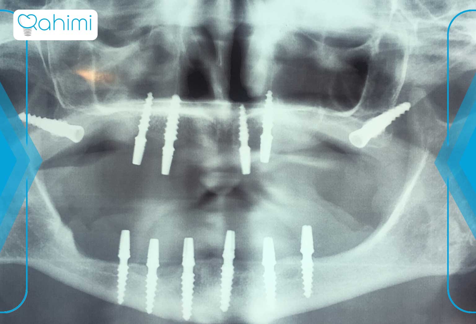 چگونه از پری ایمپلنتیت جلوگیری کنیم؟