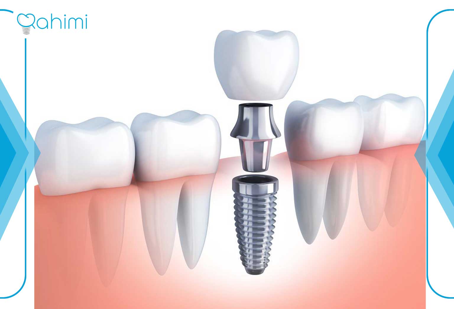 Dental implant steps