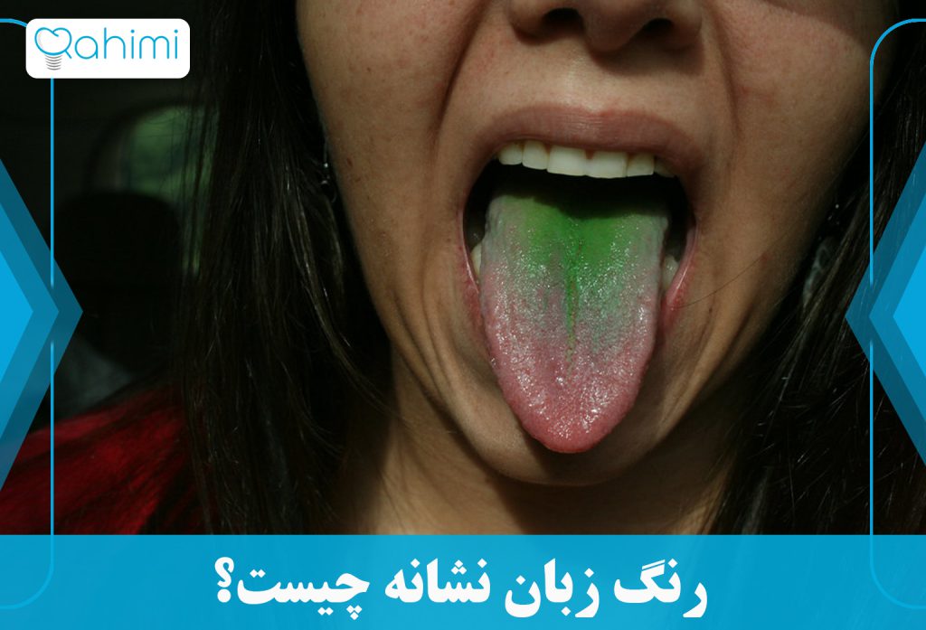 تشخیص زبان سبز و درمان سریع این بیماری 10 رنگ زبان نشانه چیست