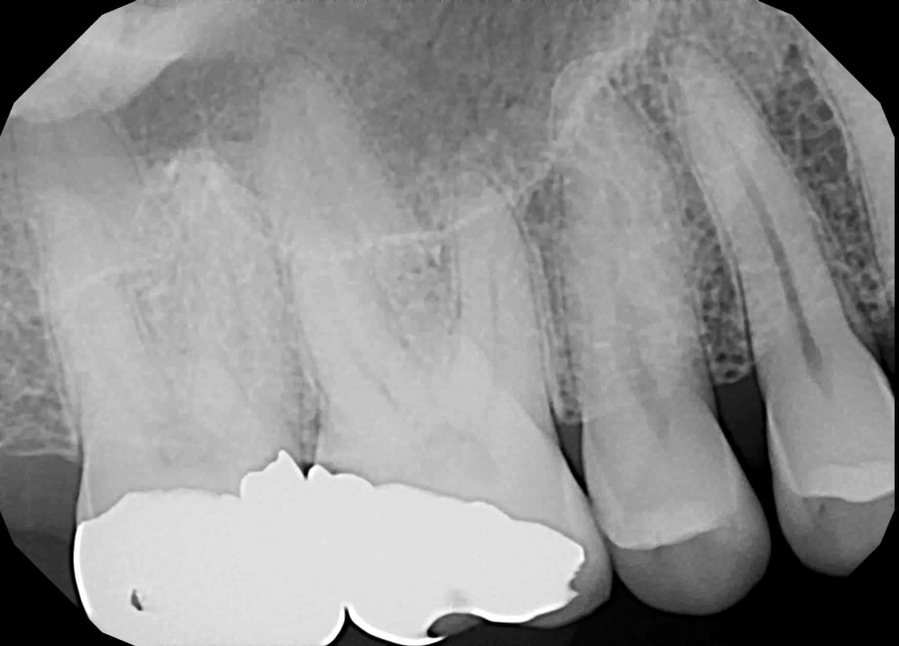 خطرات گرافی دندان