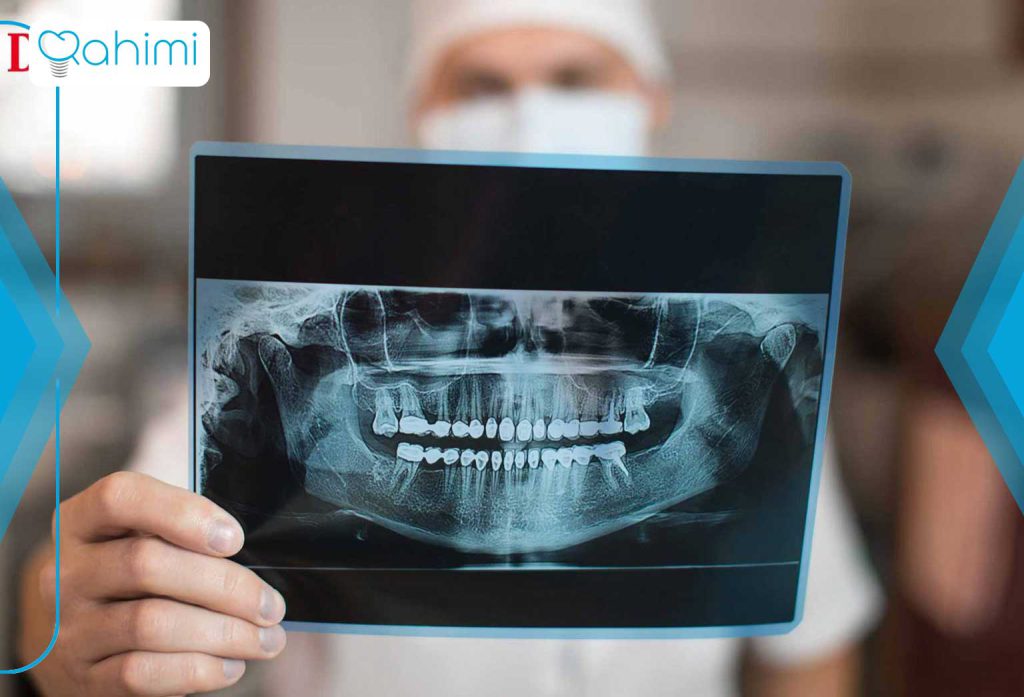 گرافی دندان 50 گرافی دندان پانورامیک چگونه انجام میشود؟