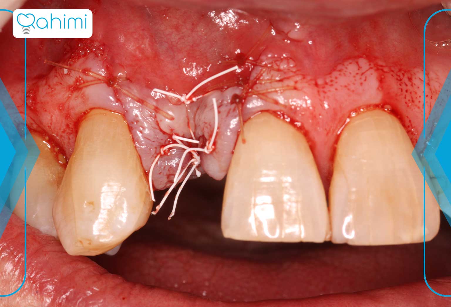 گرافت دندان و بهبودی پس از جراحی