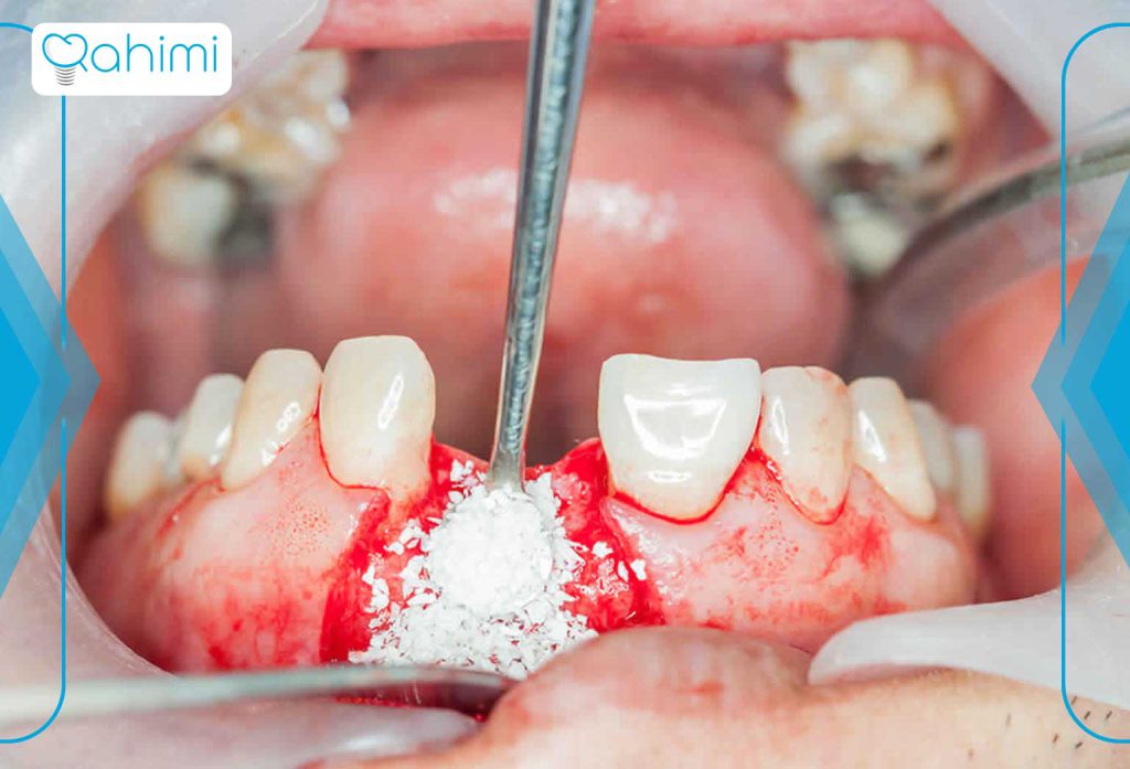 پیوند استخوان برای ایمپلنت دندان 4 انواع پیوند استخوان برای ایمپلنت دندان چیست؟