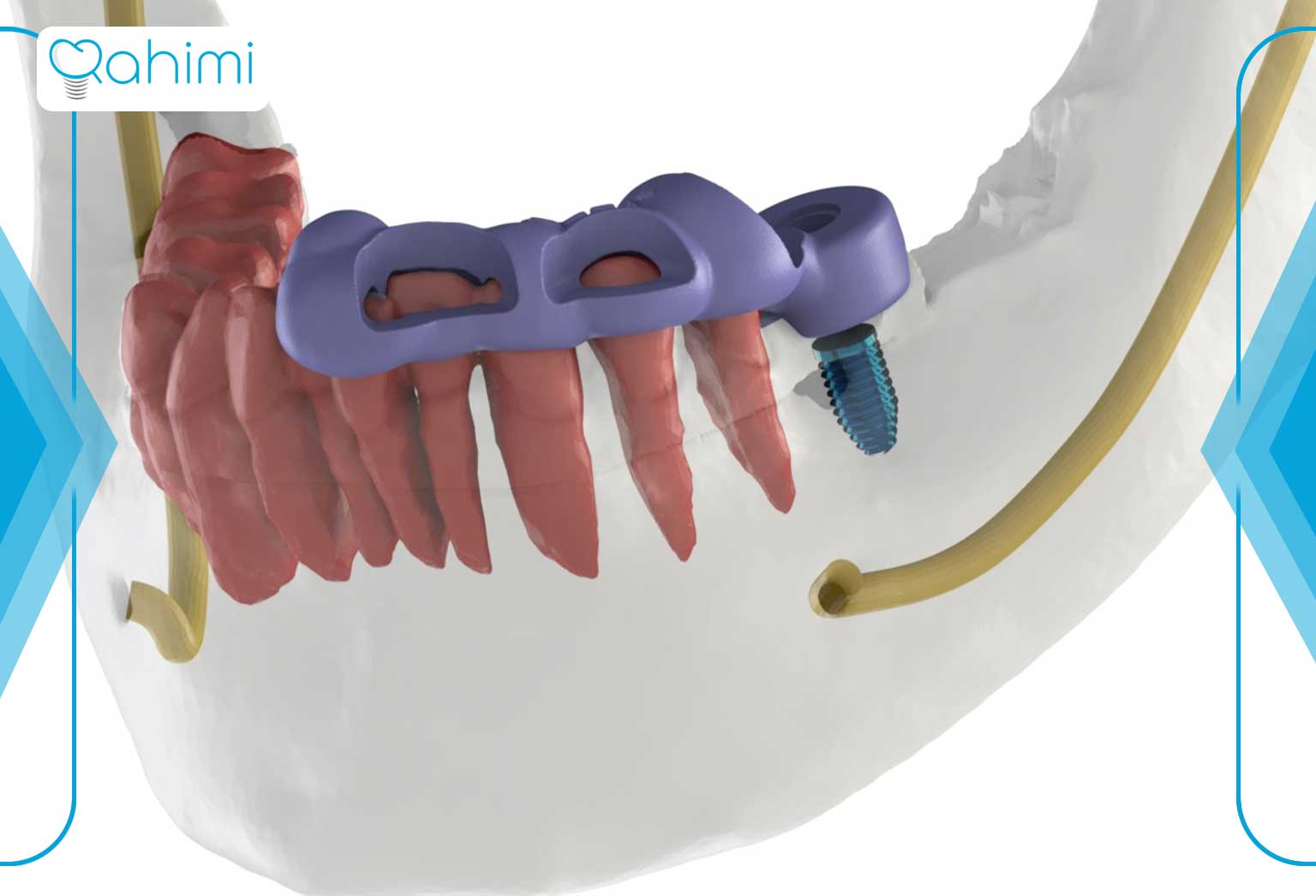 جراحی ایمپلنت هدایت شده در دندانپزشکی ایمپلنت دیجیتال