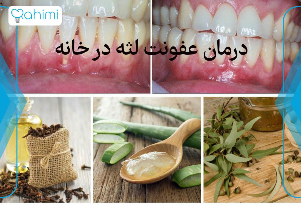 درمان عفونت لثه در خانه 5 درمان عفونت لثه در خانه