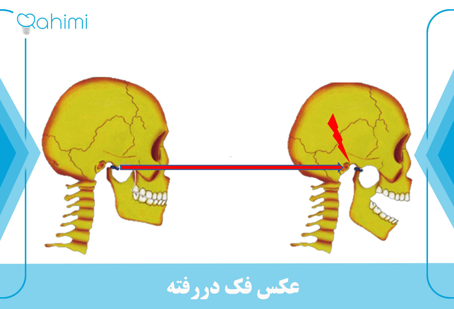 دررفتگی فک و صدای کلیک کردن فک 2 An image to recognize a dislocated jaw