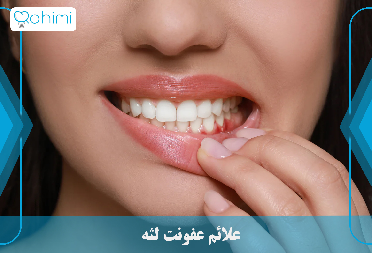 درمان عفونت لثه در خانه 1 Symptoms of gum infection 1