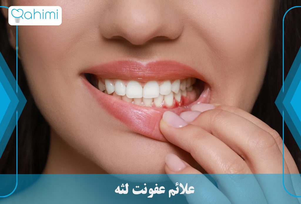 درمان عفونت لثه در خانه 1 علائم عفونت لثه