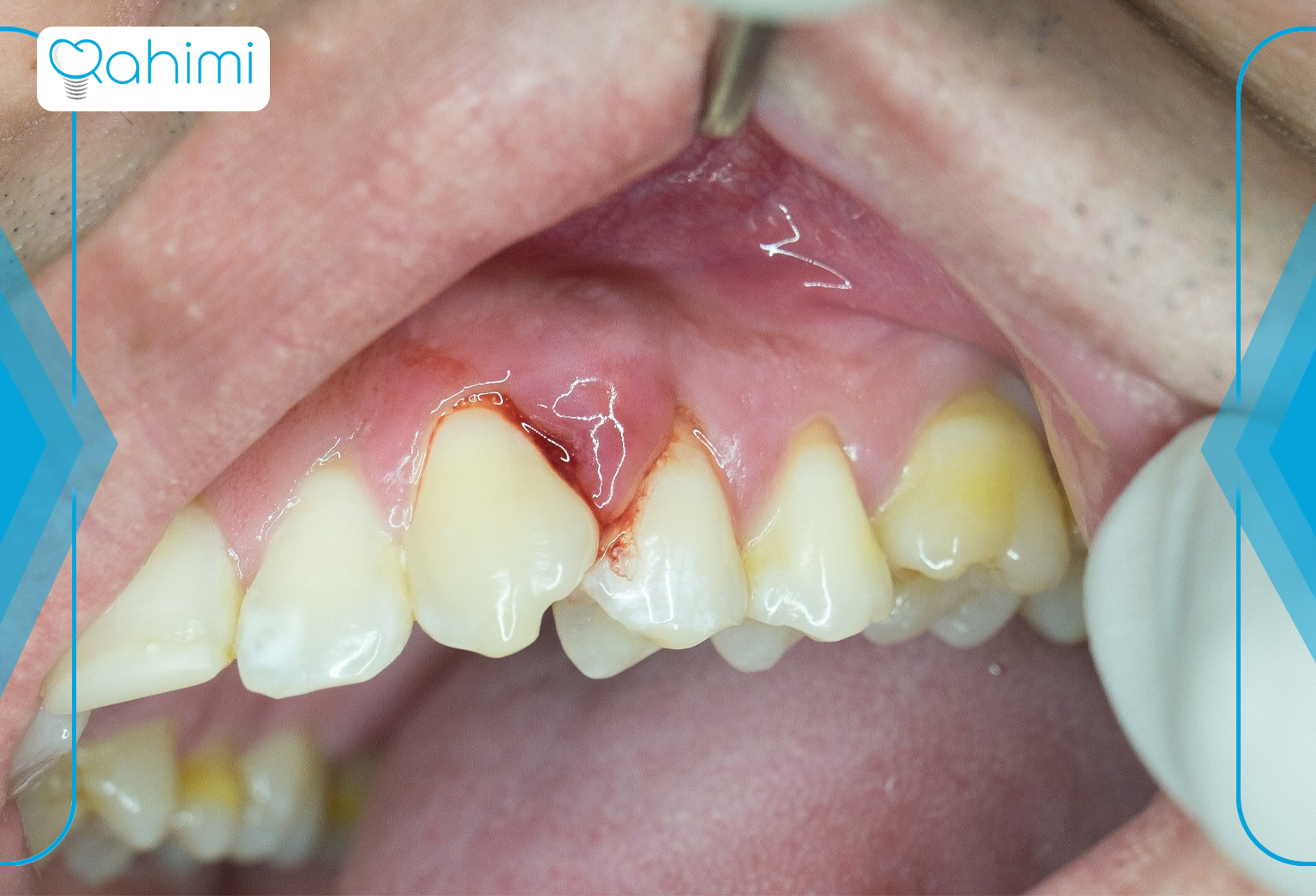 درمان عفونت لثه در خانه 2 Types of gum infection 1