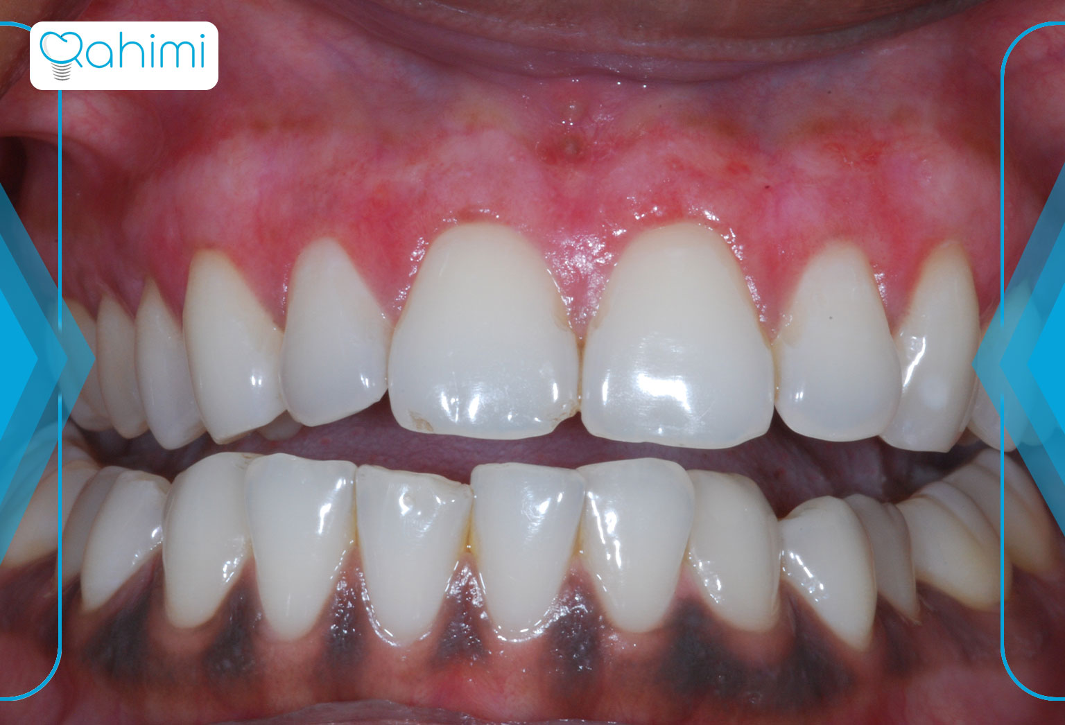 آیا ایمپلنت دندان می‌تواند باعث بیماری لثه شود؟