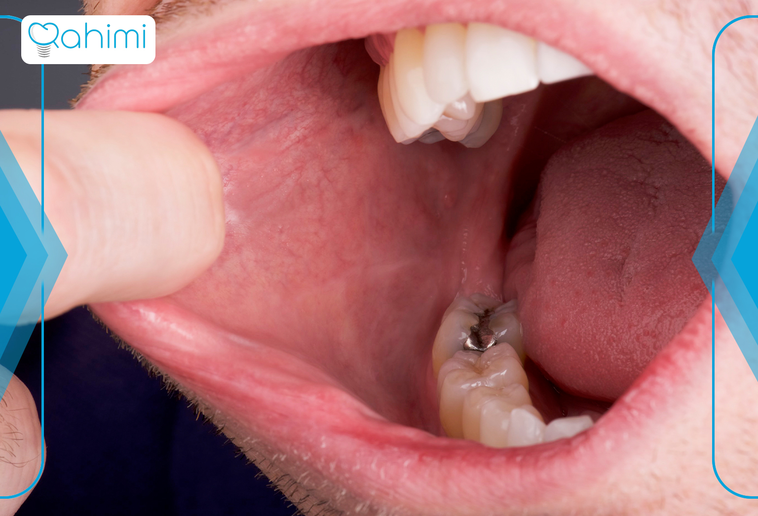  آیا ایمپلنت دندان  می‌توانند باعث سرطان دهان شوند؟