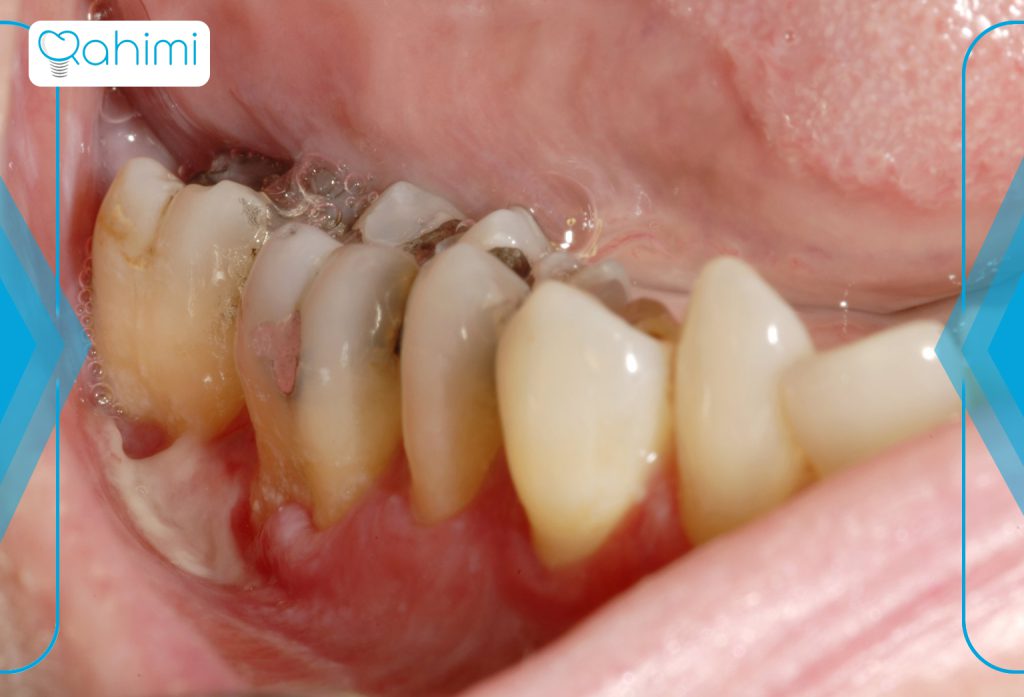 11 نشانه اصلی سرطان فک چیست؟ 12 مراحل سرطان فک