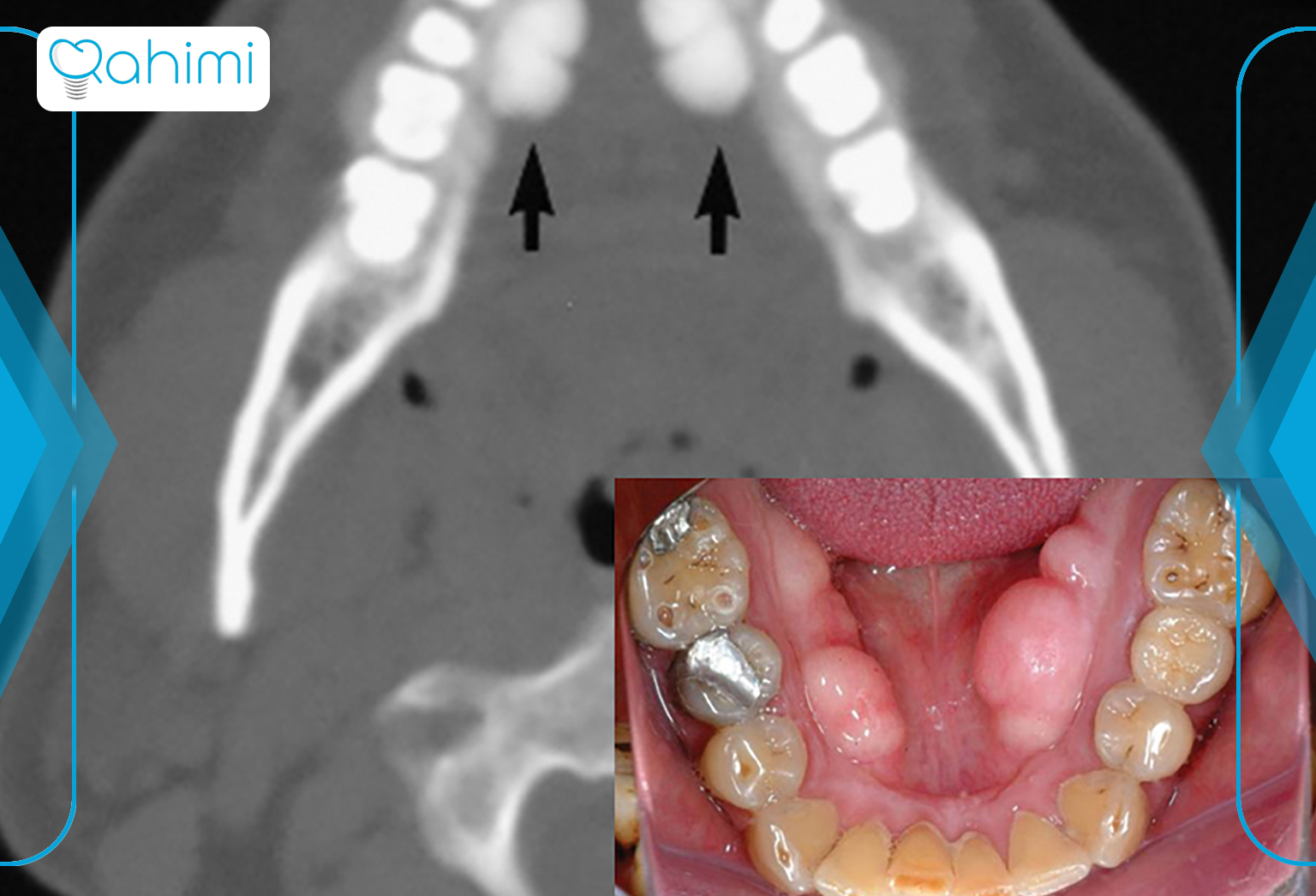 11 نشانه اصلی سرطان فک چیست؟ 5 Bone mass in the lower jaw