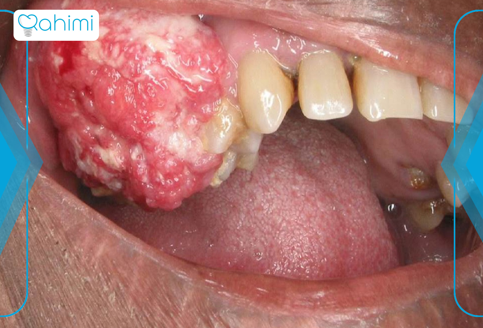 11 نشانه اصلی سرطان فک چیست؟ 7 Maxillofacial cancer