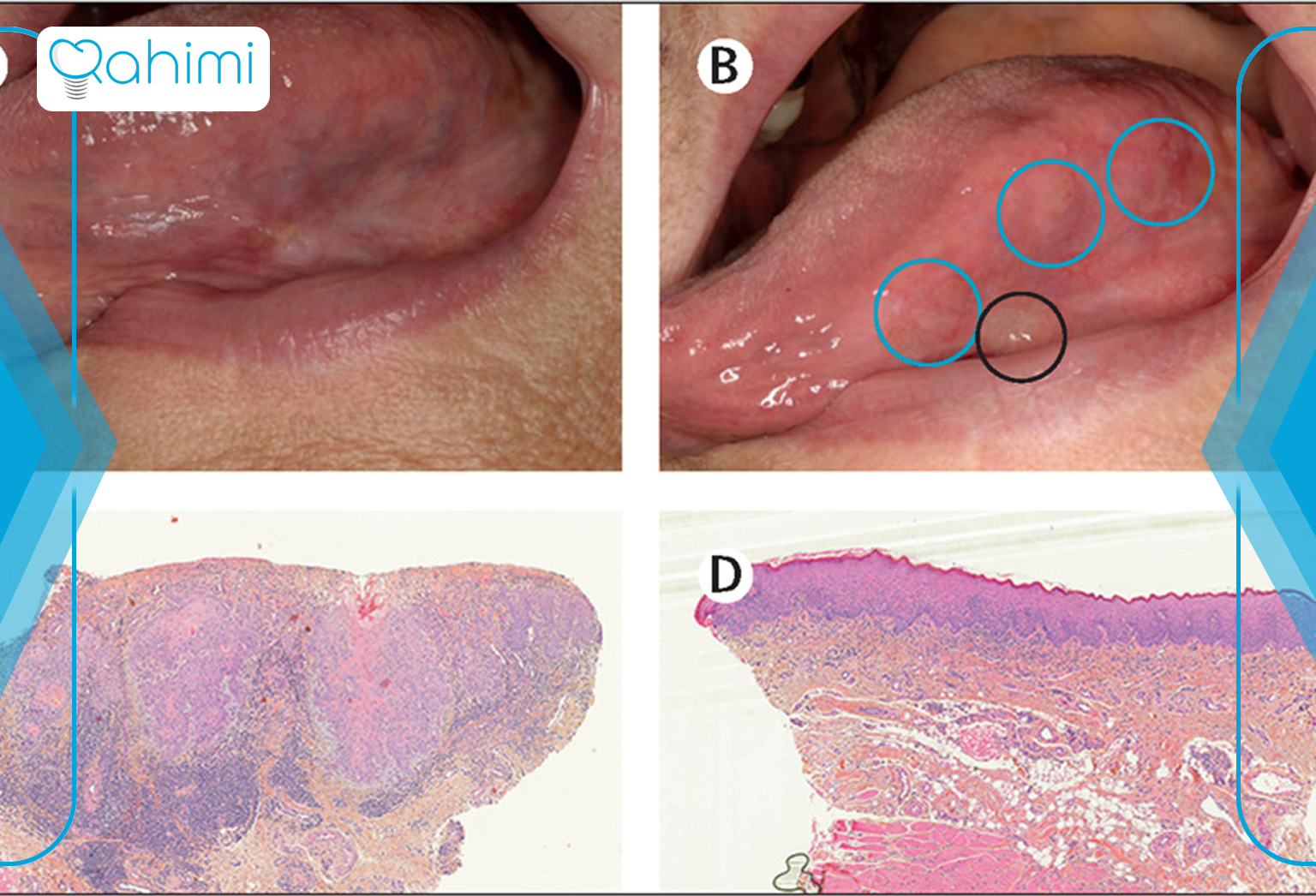 11 نشانه اصلی سرطان فک چیست؟ 15 Pictures of oral cancer