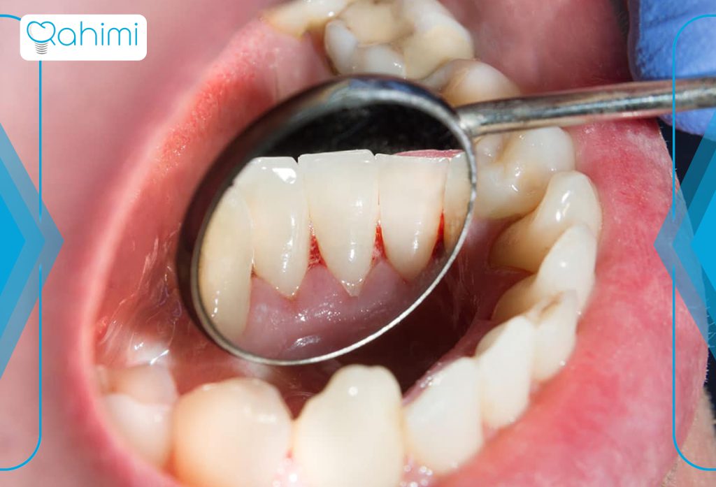 11 نشانه اصلی سرطان فک چیست؟ 9 سرطان فک کشنده