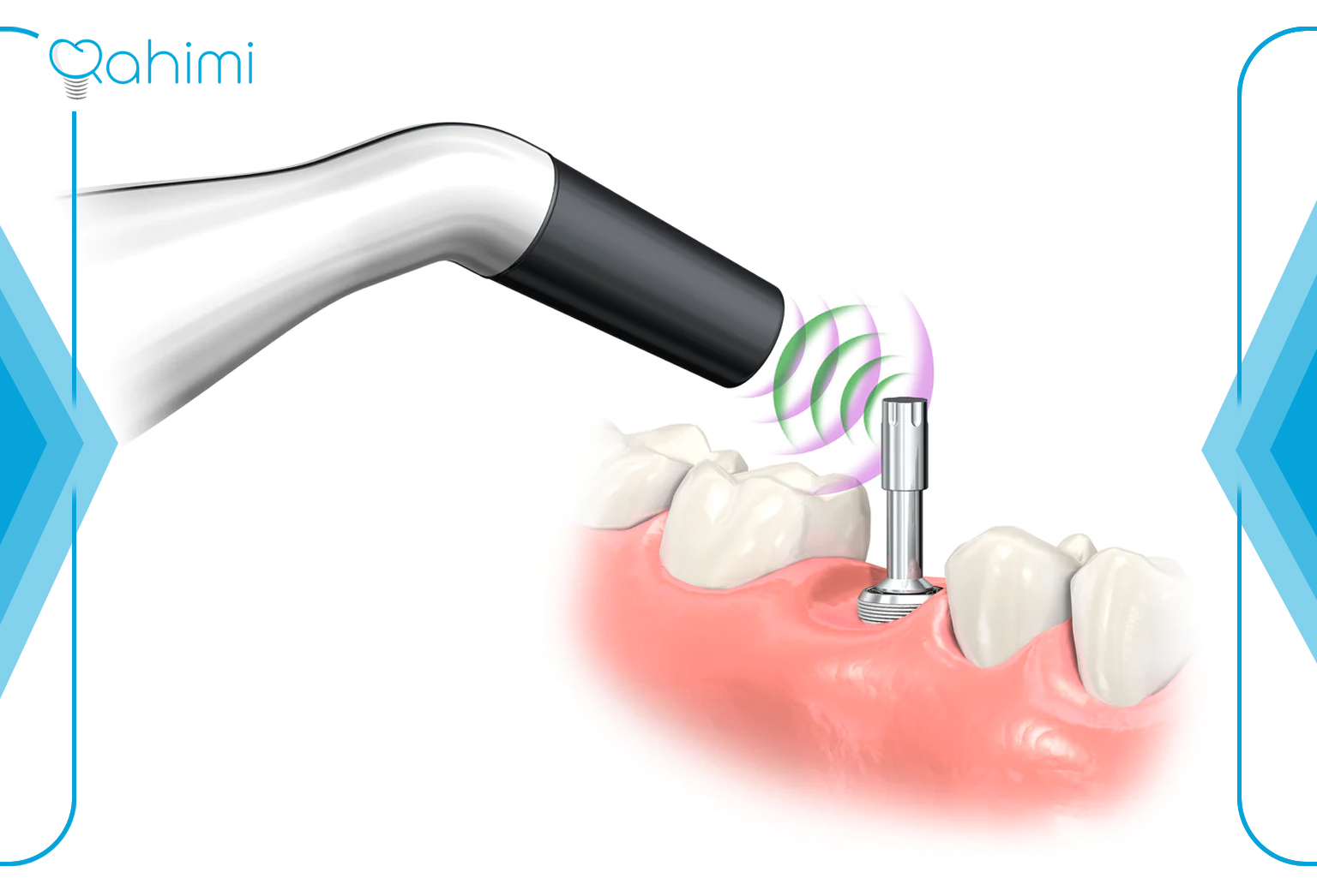 Mini implant implantation method