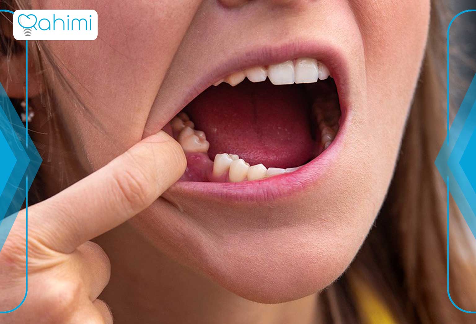 عوارض دندان غایب