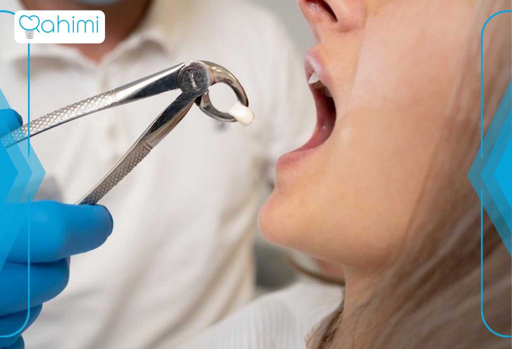 حفره خشک دندان (درای ساکت) چیست و بهترین روشهای درمان این مشکل پس از کشیدن دندان چیست؟ 4 بعد از کشیدن دندان برای پیشگیری از حفره خشک دندان