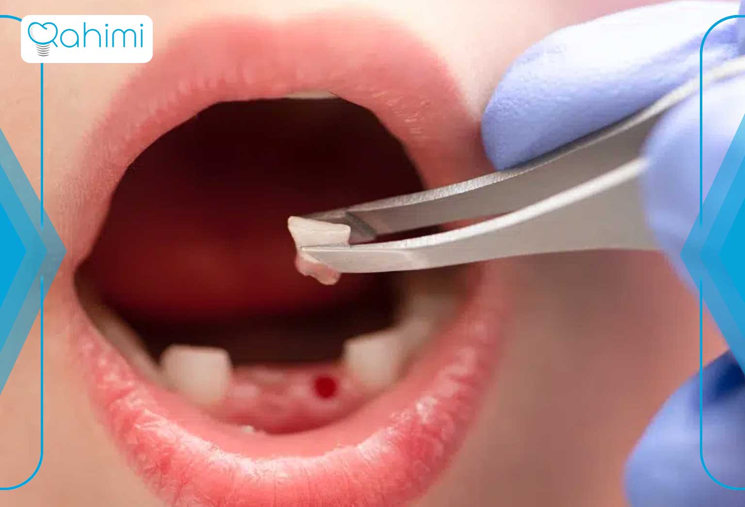 درمان حفره خشک دندان (درای ساکت)