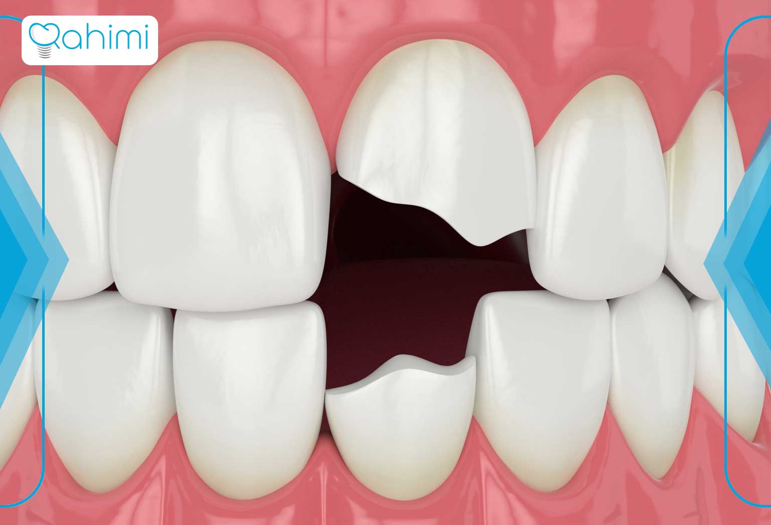 مشکلات ناشی از شکستن ایمپلنت دندان