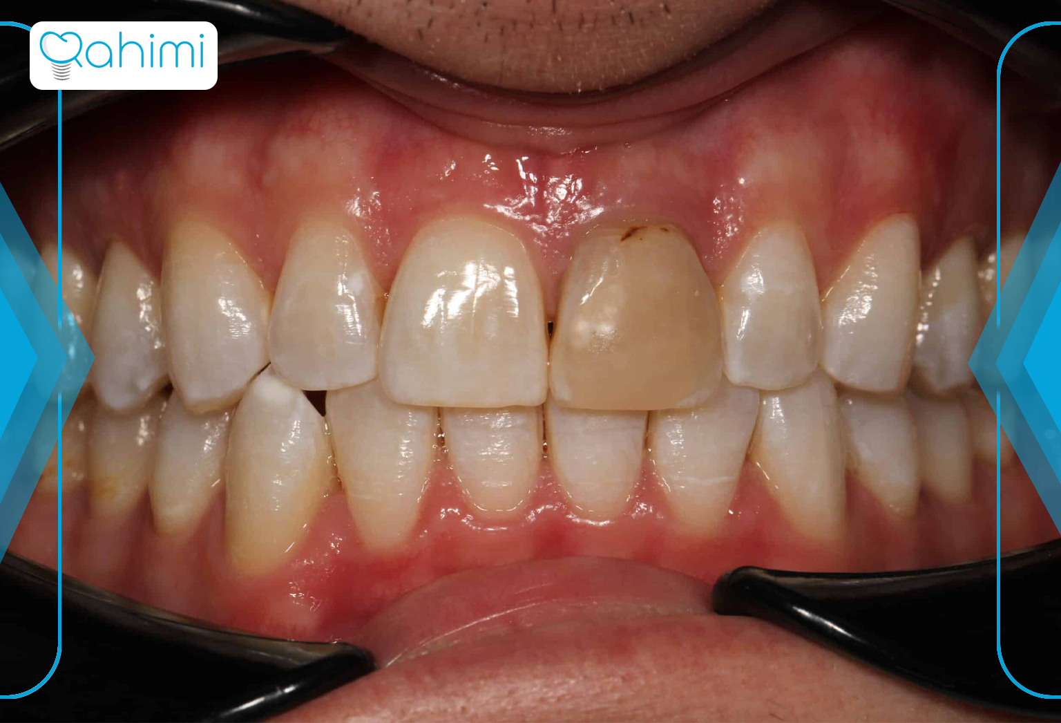 دلیل سیاه شدن دندان و بهترین روش های درمان سیاهی دندان 8 Blackening of teeth after composite